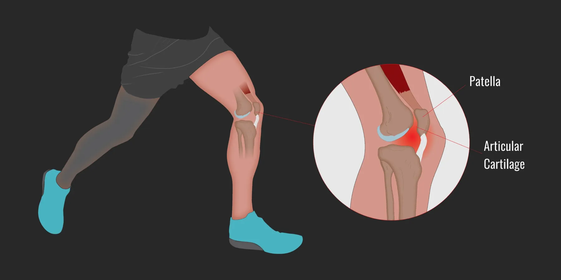 Runner's Knee.jpg