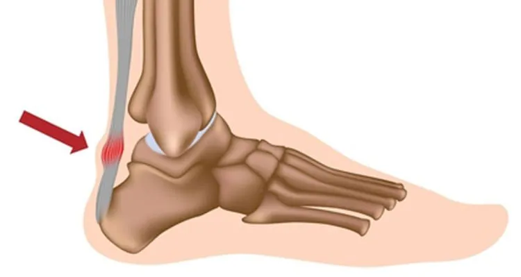 achilles-tendon-pain.jpg